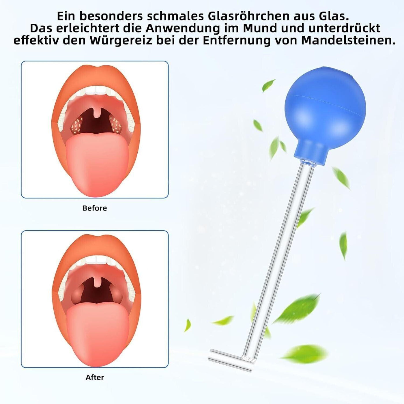Tonsillensteinentferner zum Entfernen von Mandelsteinen | Schröpfglas gegen Mand